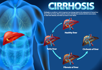 Wall Mural - Informative poster of alcoholic liver disease Cirrhosis