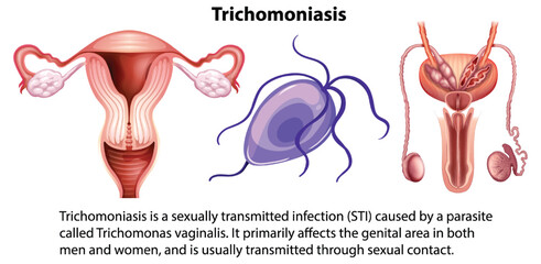 Wall Mural - Trichomoniasis infographic with explanation