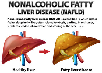 Wall Mural - Nonalcoholic Fatty Liver Disease