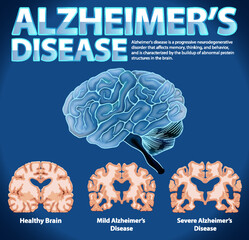 Sticker - Informative poster of Alzheimers disease