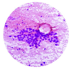 Poster - Photomicrograph of fine needle aspiration (FNA) cytology of a pulmonary (lung) nodule showing adenocarcinoma, a type of non small cell carcinoma.