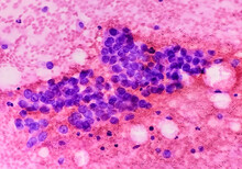 Photomicrograph Of Fine Needle Aspiration (FNA) Cytology Of A Pulmonary (lung) Nodule Showing Adenocarcinoma, A Type Of Non Small Cell Carcinoma.