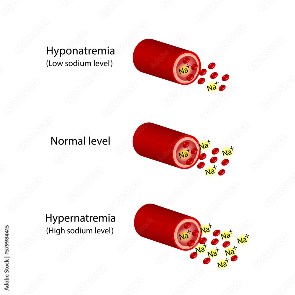 Hypernatremia High Level Of Sodium In The Blood