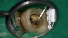 Dentist Is Filling Hole In Decay Tooth With Special Liquid Medicine With Irrigator To Disinfect From Bacterium. Macro Footage Of Doctor Treating Rotten Chewing Molar With Mirror And Probe In Clinic