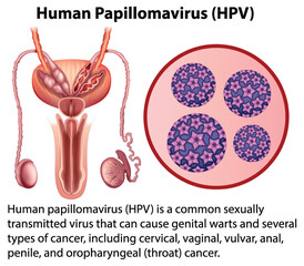 Wall Mural - Human Papillomavirus with explanation