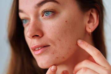 Wall Mural - Young woman with problem skin and acne closeup