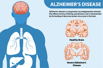 Canvas Print - Informative poster of Alzheimers disease