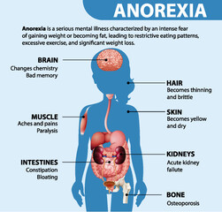 Canvas Print - Informative poster of Anorexia eating disorder