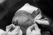 FUE hair Transplant Patient in Clinic. Hair transplant patient in the end of the operation