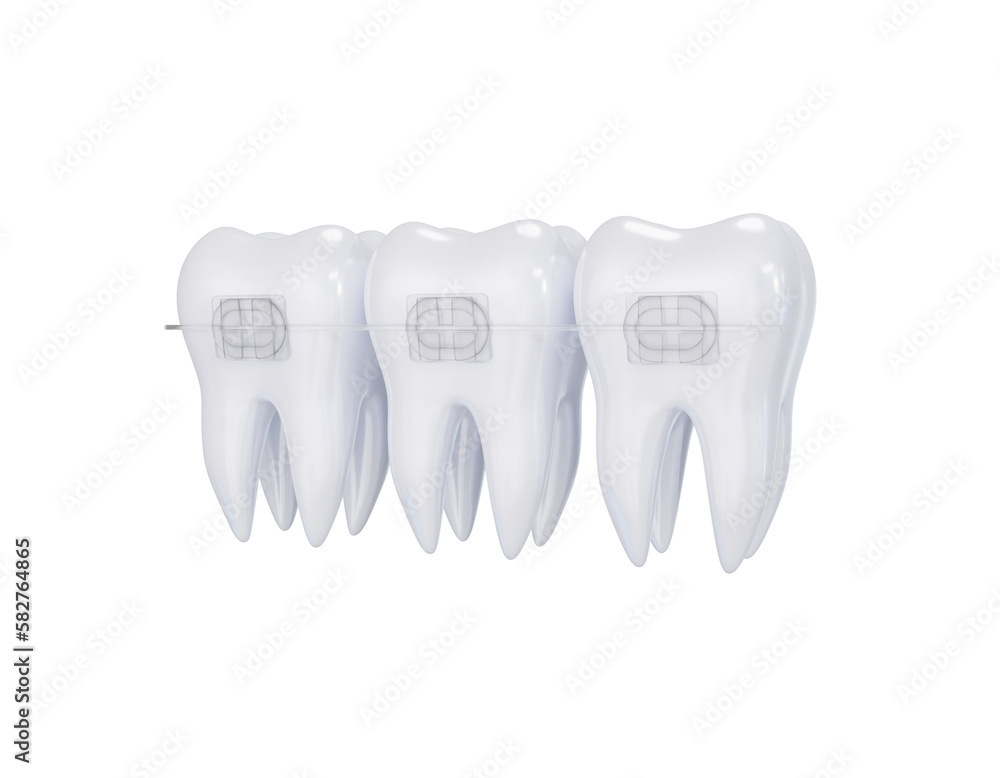 Teeth ceramic braces. Teeth alignment. Three white teeth with braces on ...