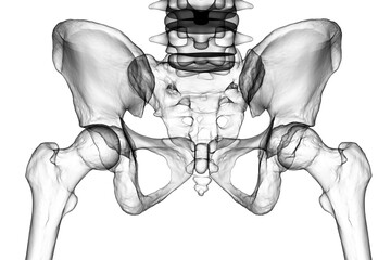 Canvas Print - Femur bone affected by Legg-Calve-Perthes Disease, a childhood hip disorder, 3D illustration