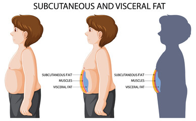 Canvas Print - Subcutaneous and visceral fat diagram