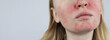 © Siniehina - Rosacea face. The girl suffers from redness on her cheeks. Couperosis of the skin. Redness and capillary mesh are visible on the face. Treatment and removal. Vascular surgery and dermatology