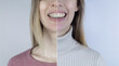 Before and after remove braces. On left is a girl in a metal bracket system, and on right are straight teeth after the procedure. Concept of correcting a smile and straightening teeth. Close-up