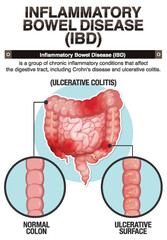 Wall Mural - Inflammatory Bowel Disease (IBD) Infographic