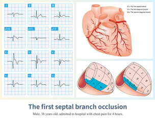 Wall Mural - When isolated first septal branch occlusion occurs, it causes acute anteroseptal myocardial infarction and ST segment elevation in leads V1 to V2-V3.