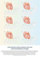 Wall Mural - When different parts of the left coronary artery are occluded, it can lead to ST segment elevation or depression in different chest leads on the electrocardiogram.