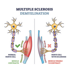 Sticker - Multiple sclerosis demyelination compared with medical healthy nerves outline diagram. Labeled educational scheme with anatomical and medical autoimmune disease muscle contraction vector illustration