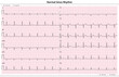 © alfa md - ECG Normal Sinus Rhythm - 12 Lead ECG Common Case - 6 Sec/lead - Vector Medical Illustration