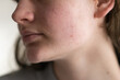 © Анастасія Стягайло - Problem skin face. A teenage girl with a troubled face. Problematic teenage skin. Care for problem skin. Acne remedy. Acne.