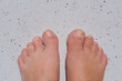 close-up of female feet, toe of right bare foot is inflamed and enlarged, problem of rheumatoid arthritis, chronic inflammation of joints, medical care, treatment of diseases of musculoskeletal system