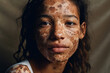 Young african american woman with vitiligo. Inclusion concept. Different. Generative AI.