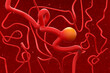 Brain artery aneurysm (Cerebral Aneurysm) - 3d illustration isometric view