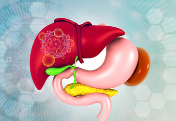 Wall Mural - Liver cancer, human digestive system. 3d illustration.