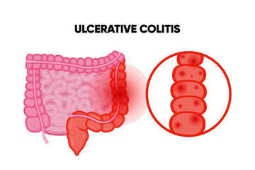 Ulcerative Colitis. Inflammatory bowel disease. Ulcer and inflammation of the digestive tract, abdominal pain. Human internal organ, anatomy, medicine concept, healthcare.