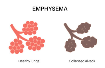 Canvas Print - Emphysema anatomical poster