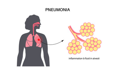 Wall Mural - Pneumonia infection poster