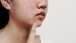 © NanSan - Asian teenage with acne face skin problem, Dermatological disease, white background.