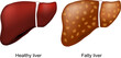fatty liver disease. Healthy liver and hepatic steatosis.