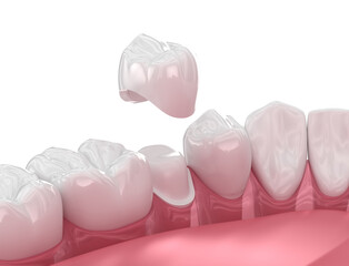 Wall Mural - Dental crown placement over tooth. 3D illustration