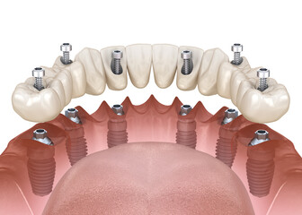 Wall Mural - Mandibular prosthesis with gum All on 6 system supported by implants.  Medically accurate 3D illustration of human teeth and dentures concept