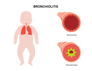 Canvas Print - Bronchiolitis lung disease