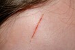 Wound on the scalp of a child close-up
