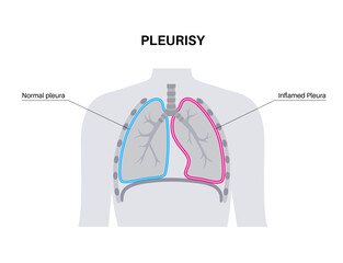 Canvas Print - Pleurisy inflammation diseases