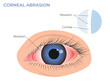 Corneal abrasion illustration. Eye redness symptom. pink red surfer's eye