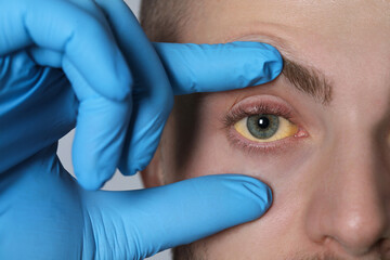 Poster - Doctor checking yellow eyes of patient on light grey background, closeup. Hepatitis symptom