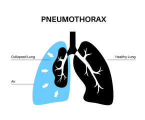 Wall Mural - Pneumothorax anatomical poster