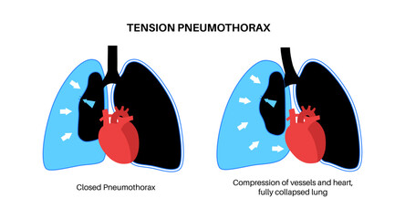 Wall Mural - Tension pneumothorax poster