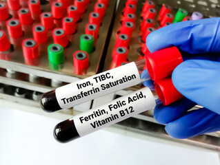 Sticker - Scientist holding blood samples for Iron, TIBC, Ferritin and Folic acid, Vitamin B12 test to diagnose  iron deficiency anemia.