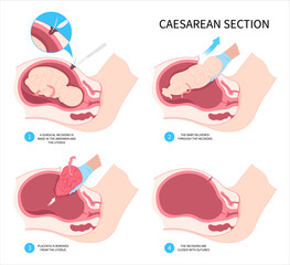 Medical Infant Childbirth Delivery Caesarean C section newborn Baby birth prolapse umbilical cord twins scar womb tummy women Fetal fetus mother belly Labour feet pain born