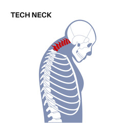 Poster - Neck vertebrae deformity