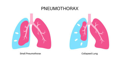 Wall Mural - Pneumothorax anatomical poster