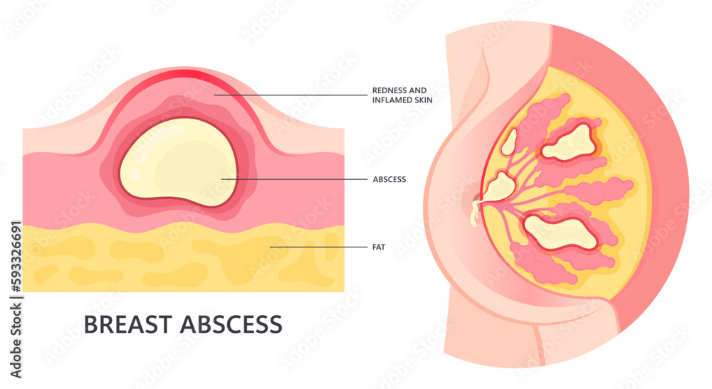 swelling breast gland engorgement cyst abscess cancer mastitis pain ...