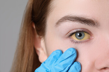 Poster - Doctor checking woman with yellow eyes on light background, closeup. Symptom of hepatitis