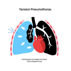 Wall Mural - Tension pneumothorax poster