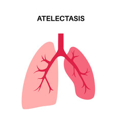 Wall Mural - Atelectasis medical poster